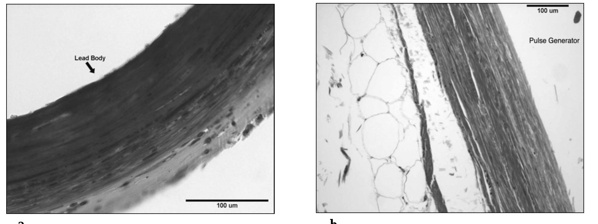 Microscopic Pacemaker (PDF) Explanted Pacemakers: Observations of the Long-term Foreign Body ...
