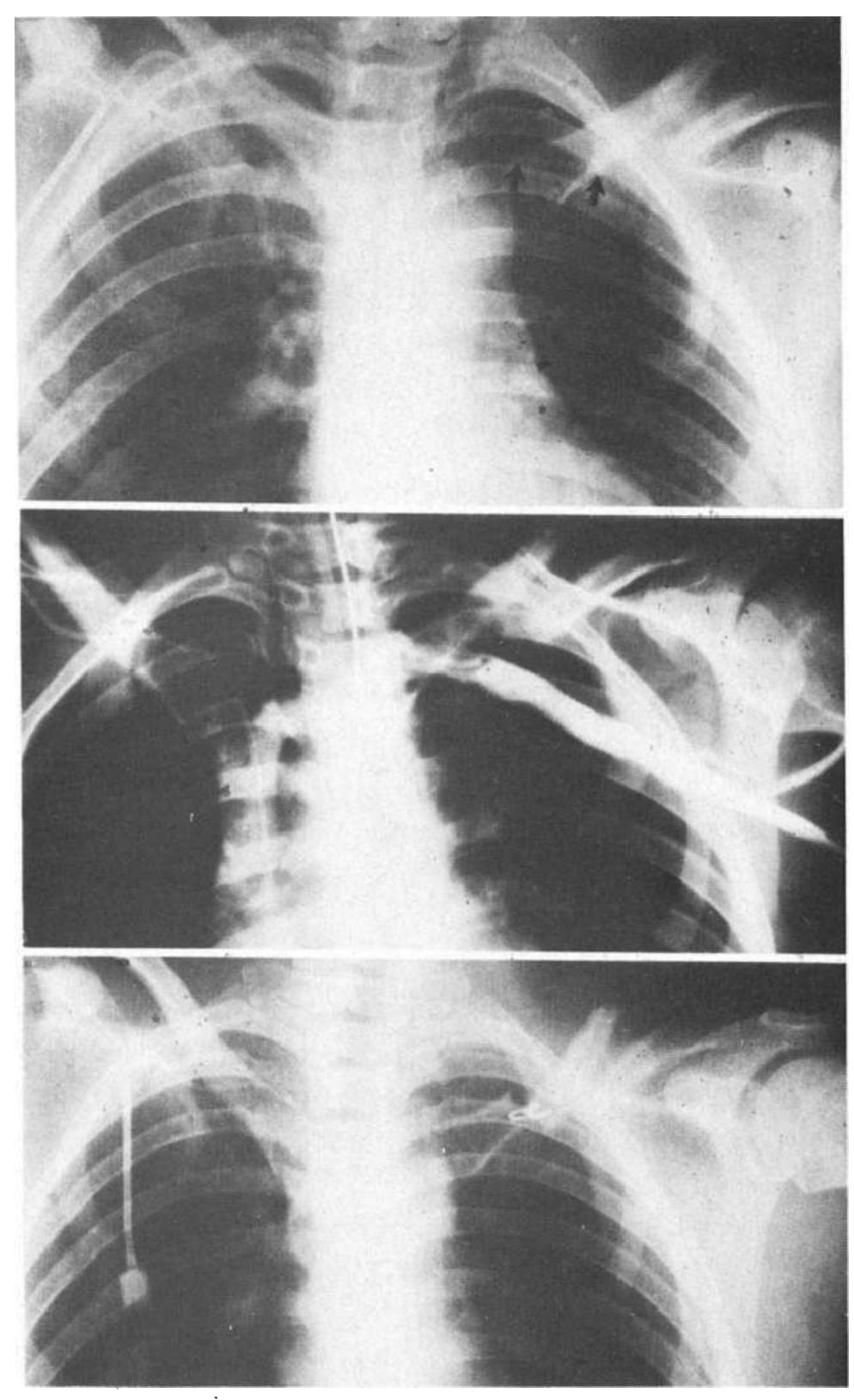 Figure 2 - from Major complications of percutaneous