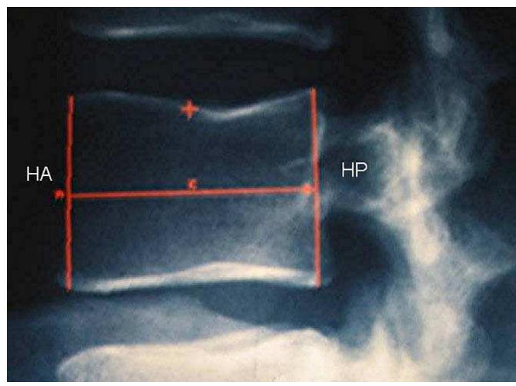 Radiographic morphometry measurement of anterior height (ah)