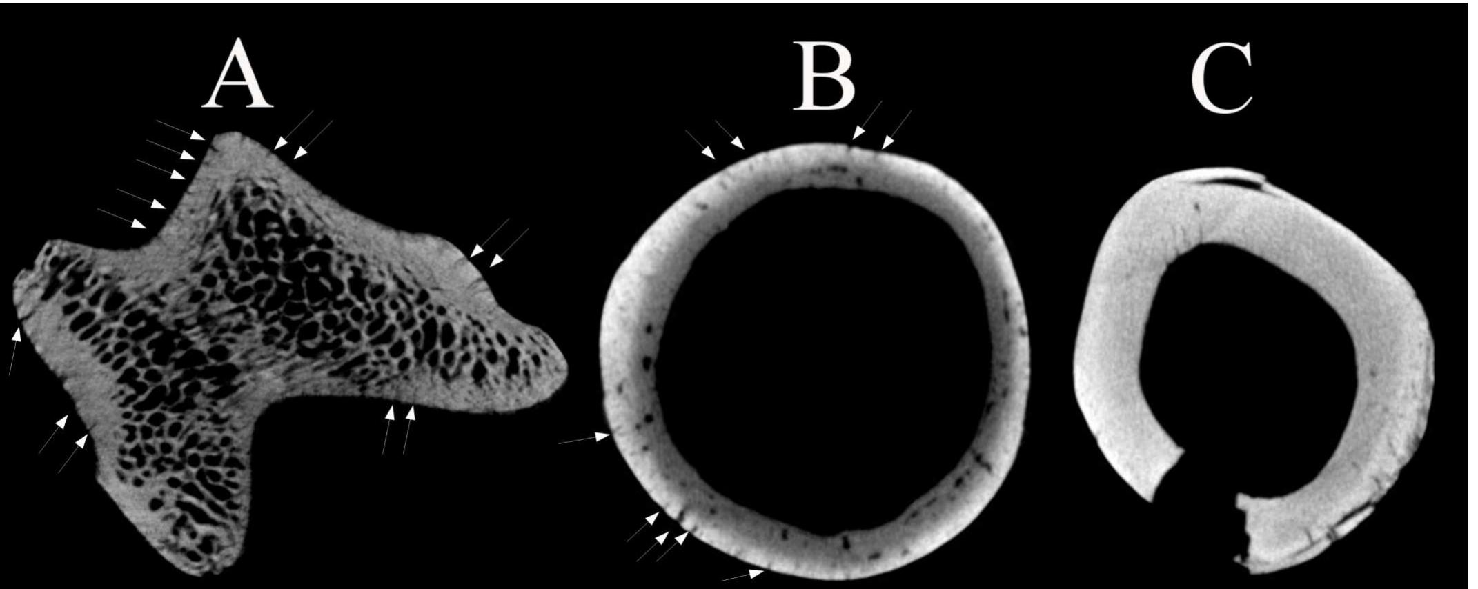 Figure 3. Cross-sections of burned specimens 1 (A), burned at 600°C, 4 (B), burned at 900°C, and 5 (C), burned at 900°C. Thin cracks perpendicular to the outer surface are visible in the cortical region of specimens A and B (white arrows). Cracks paral- lel to the outer surface, related to bone deformation, are visible in C. A change in greyscale values from the marrow cavity  to the outer surface (indicating an increase in bone density) is visible in B. 