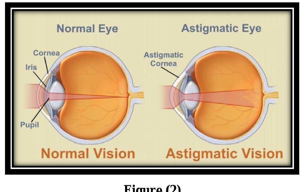 Figure 2 Astigmatism Axis and Amount Changes in Children