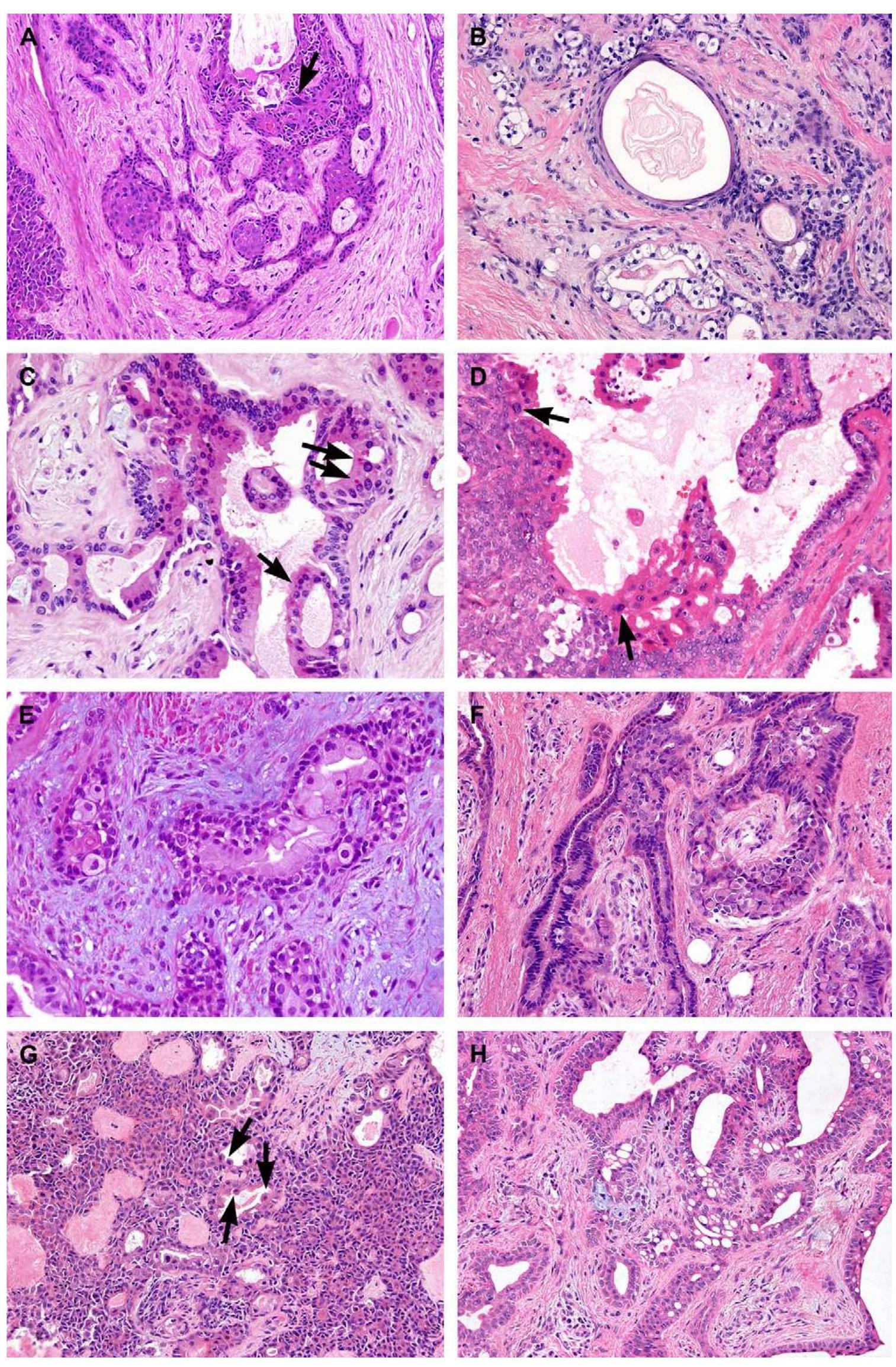 Figure 5 - from Apocrine mixed tumor of the skin (“mixed
