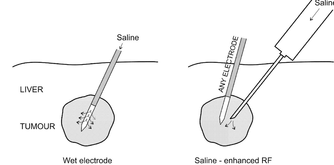Electrode system [33, 34], an expandable electrode system