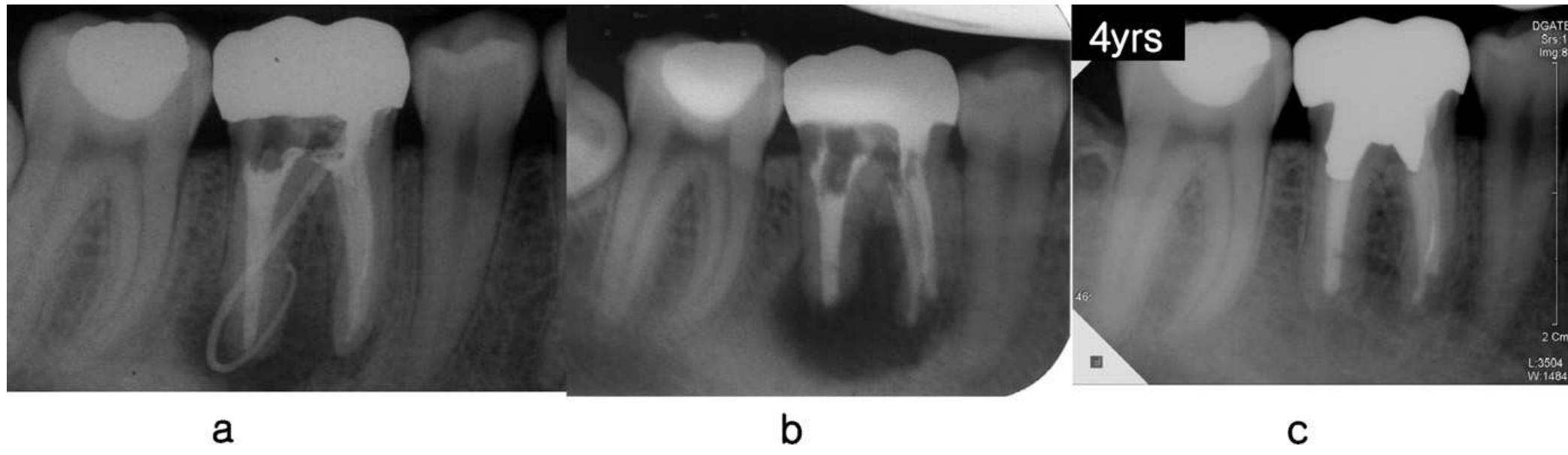 Tracing Radiograph (a) preoperative fistula tracing radiograph of tooth #30 in