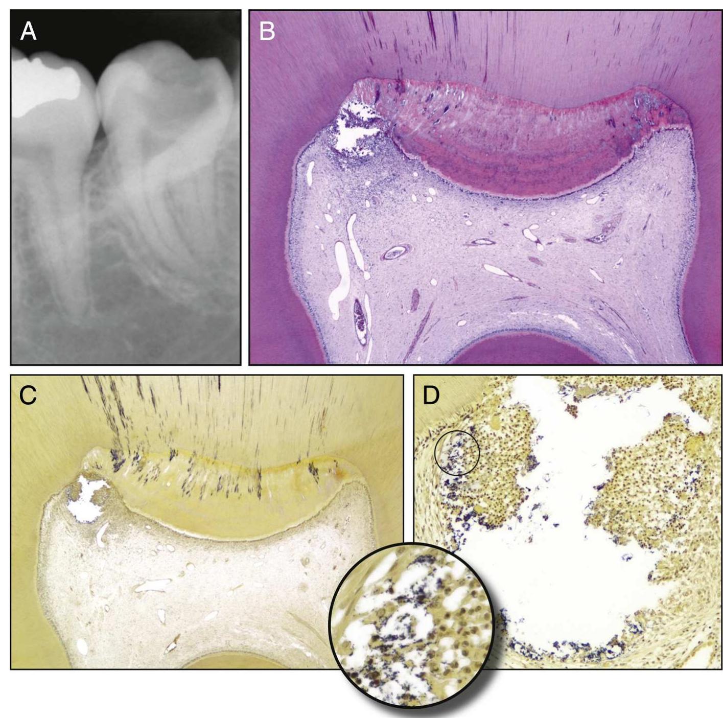 (PDF) Correlation between Clinical and Histologic Pulp Diagnoses