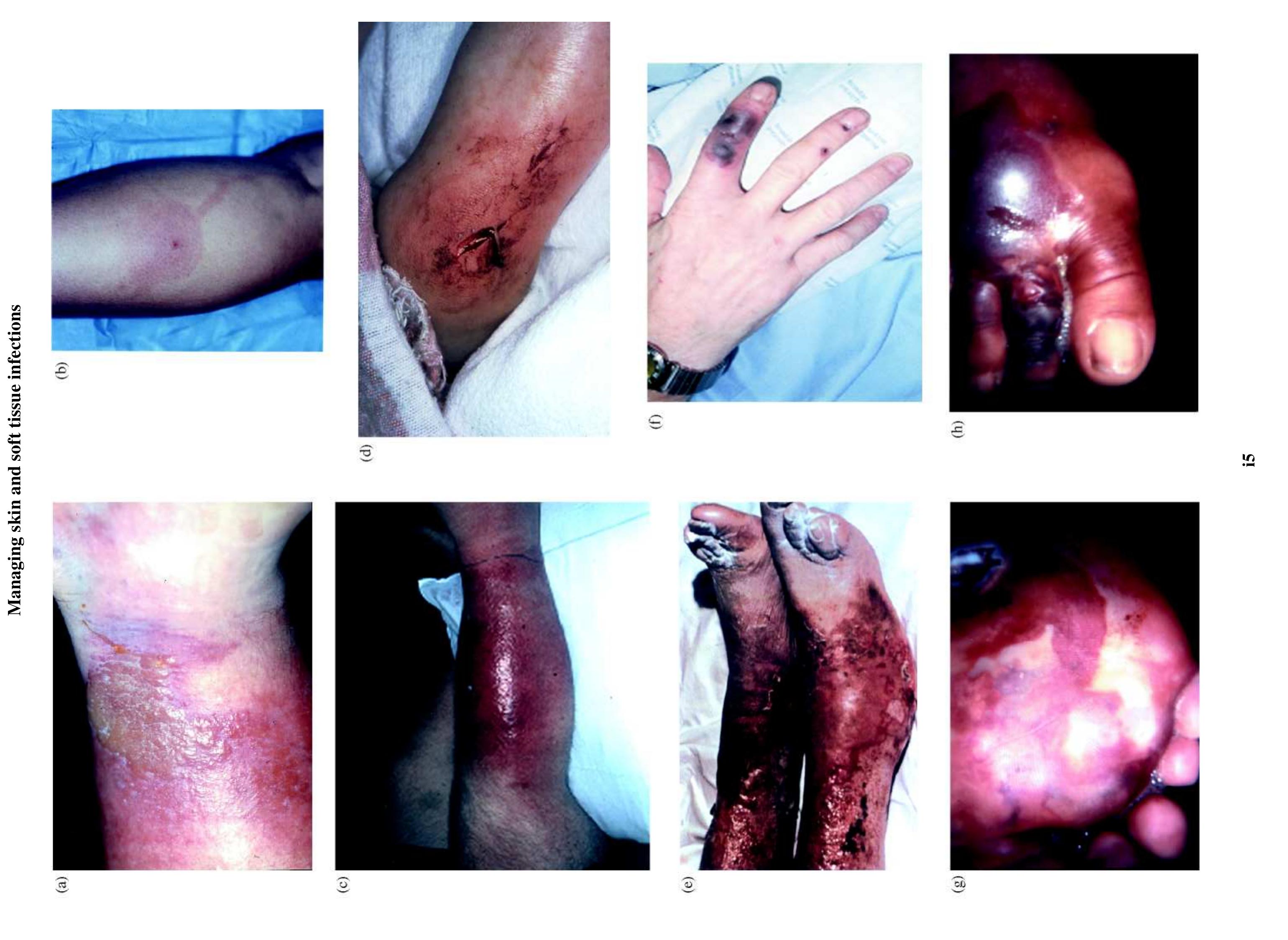 Algorithm for managing cellulitis: site of care and route of