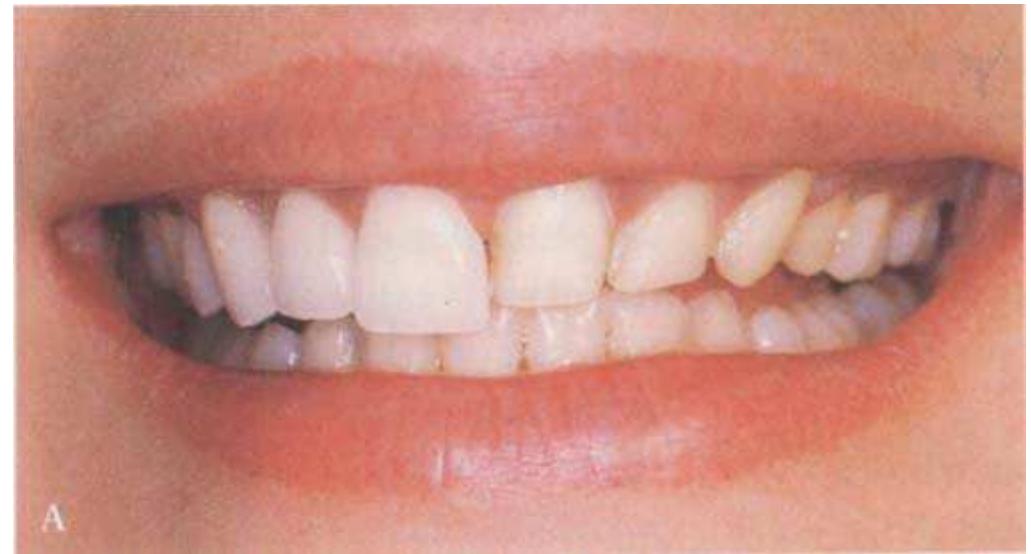 Asa Injection Example (PDF) P-ASA Block Injection: A New Palatal Technique to Anesthetize ...