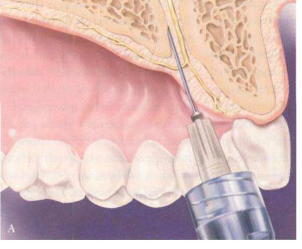 Asa Injection Example (PDF) P-ASA Block Injection: A New Palatal Technique to Anesthetize ...