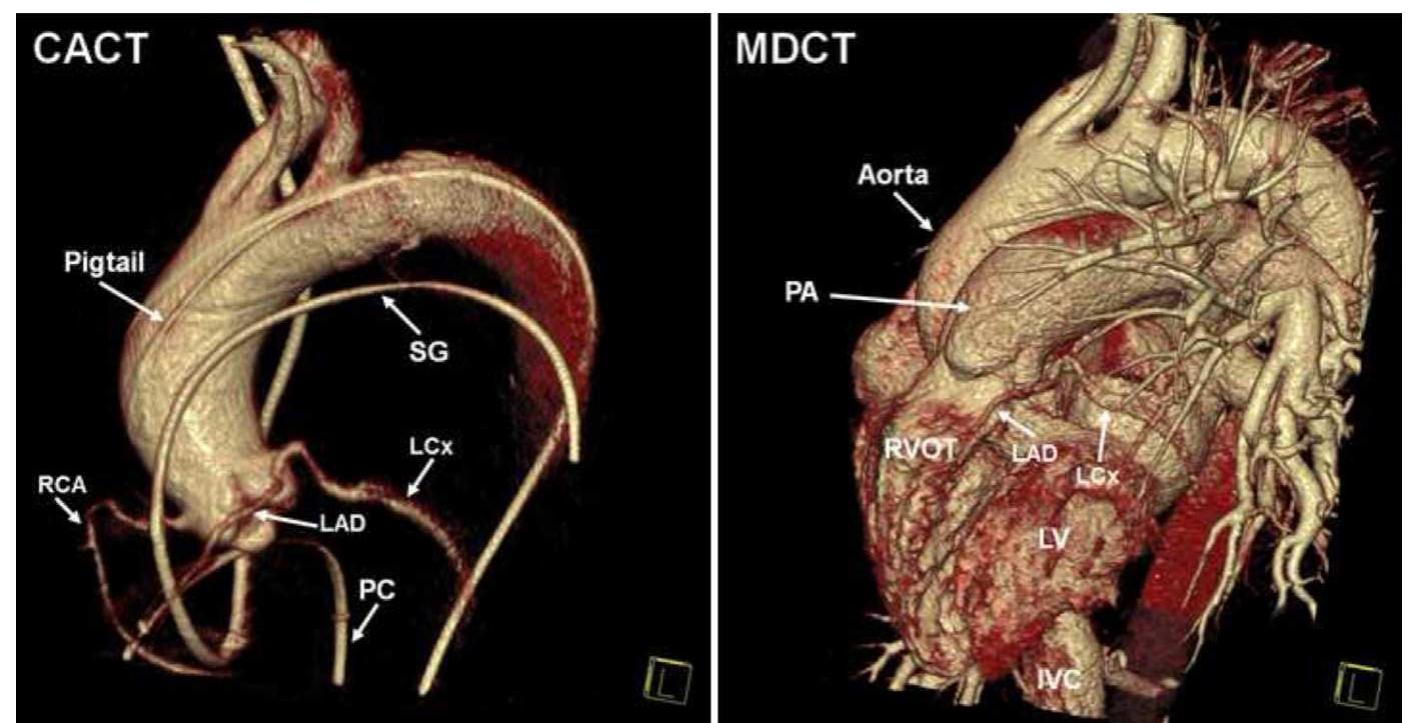 (PDF) Feasibility of C-arm computed tomography for transcatheter aortic ...