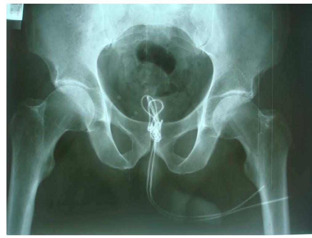 (PDF) Electrical wire as a foreign body in a male urethra: a case report