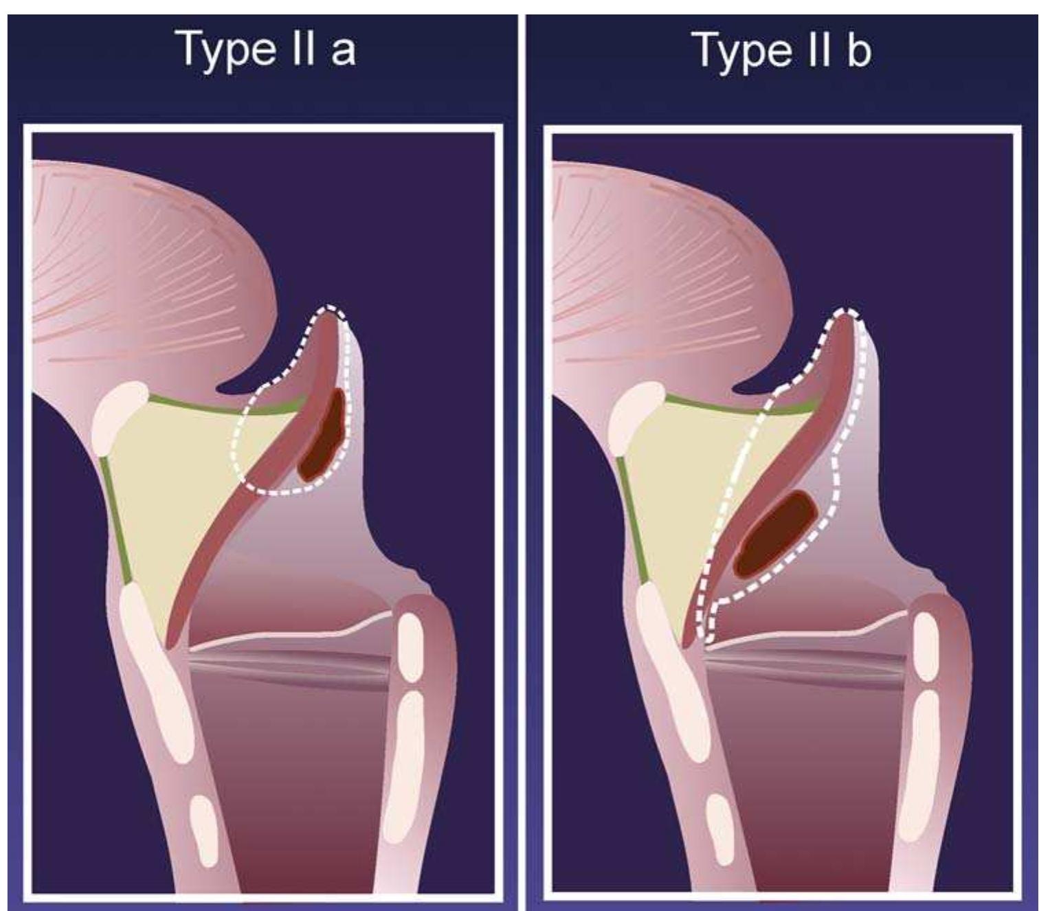 (PDF) Endoscopic supraglottic laryngectomy: a proposal for a ...