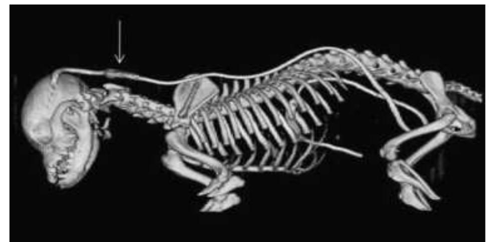 Codeman Vp (PDF) Long-term evaluation of a new ventriculoperitoneal shunt valve ...