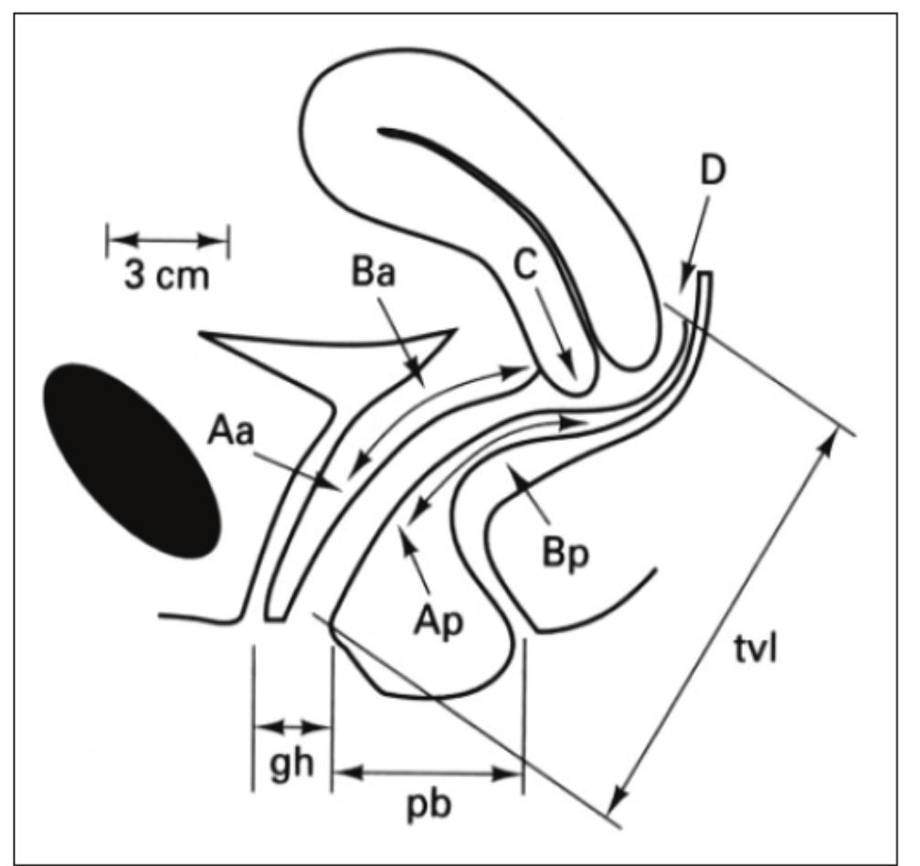 (PDF) Pelvic Organ Prolapse Quantification System (POP-Q) - a new era ...