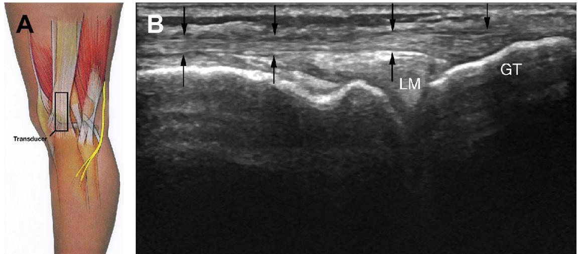 (PDF) Ultrasound of the Knee