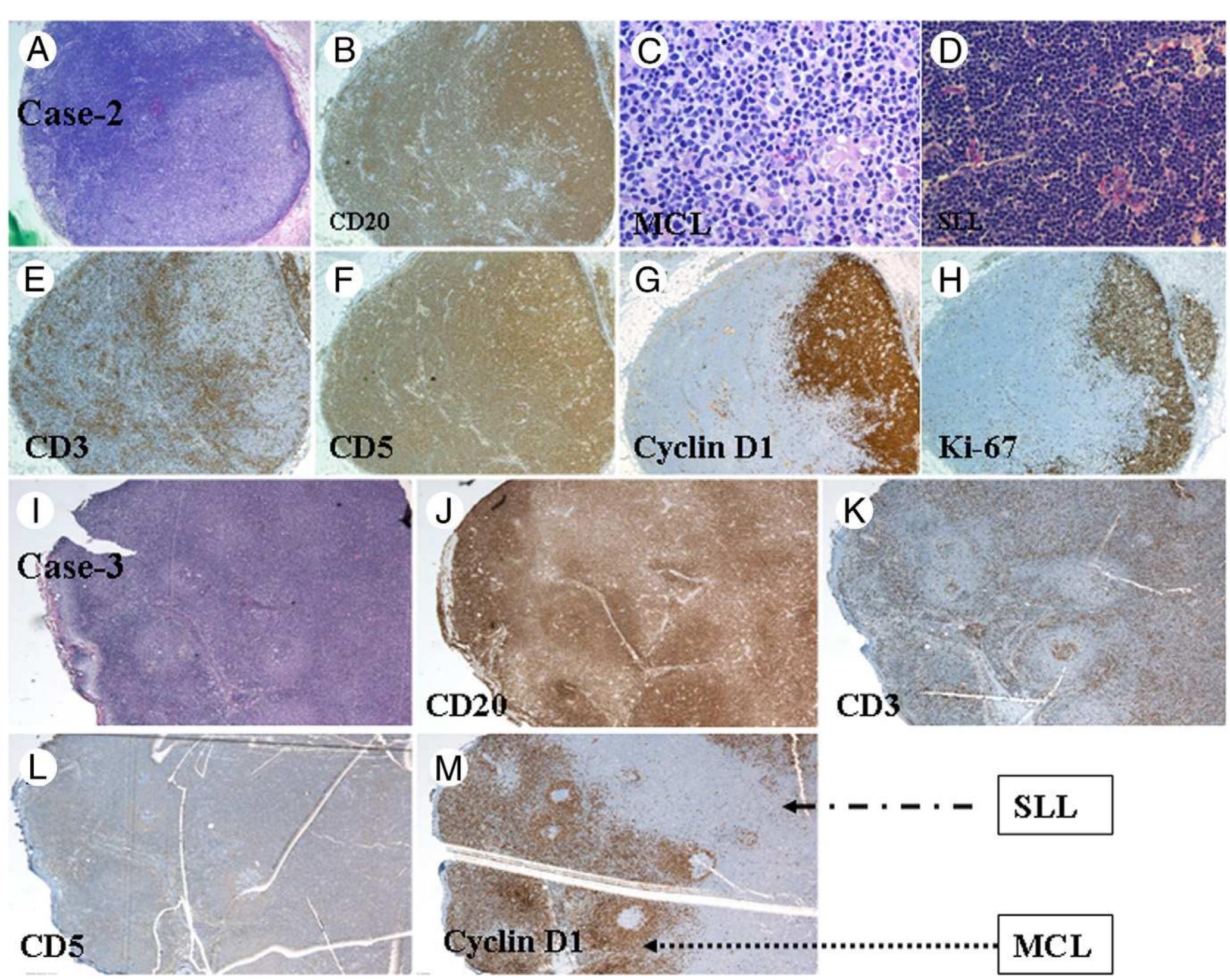 (PDF) Composite mantle cell lymphoma and chronic lymphocytic leukemia ...