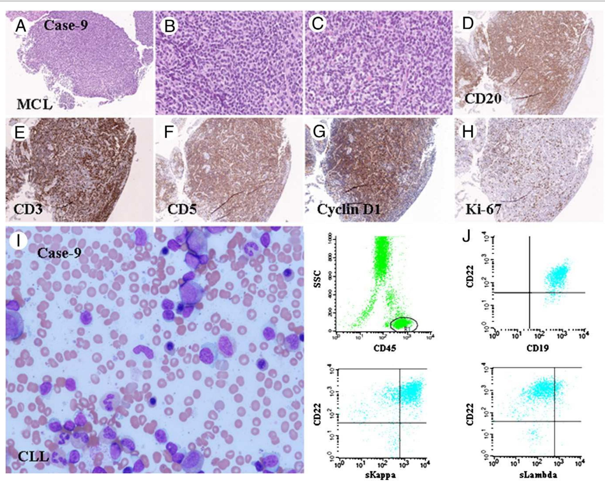 (PDF) Composite mantle cell lymphoma and chronic lymphocytic leukemia ...