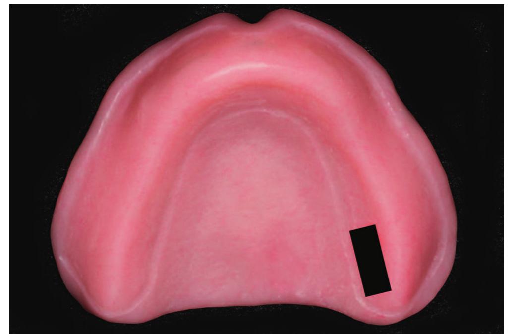 (PDF) Complete denture fabrication with CAD/CAM record bases