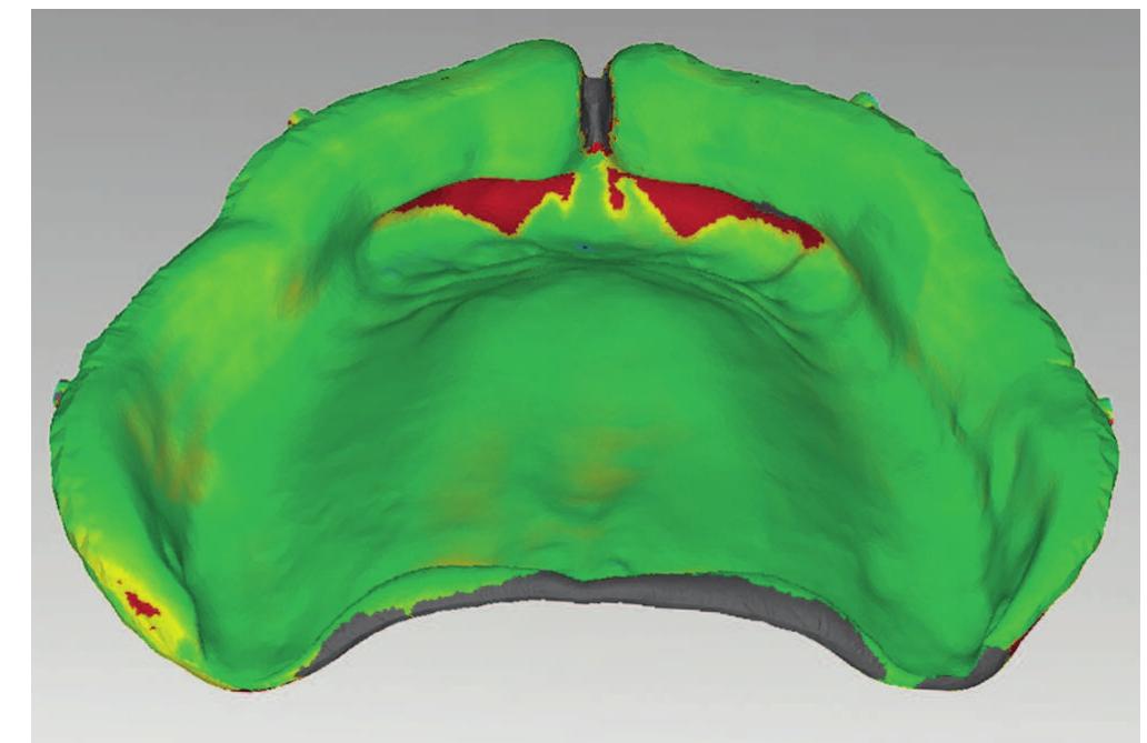 (PDF) Complete denture fabrication with CAD/CAM record bases