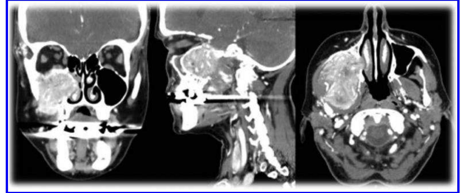 38 coronal, sagittal, and axial ct scan views of a malignant