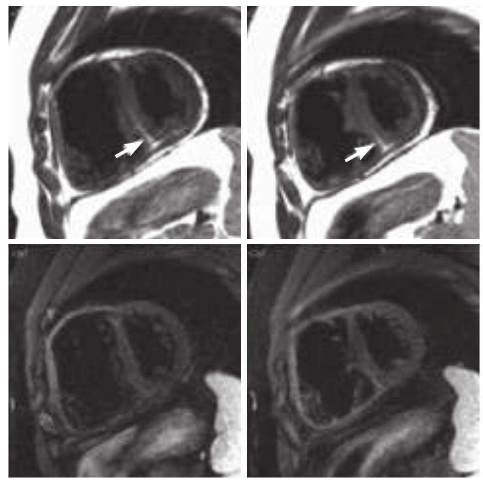 Pathologic Kin Members Idiopathic fatty myocardium. black blood images obtained