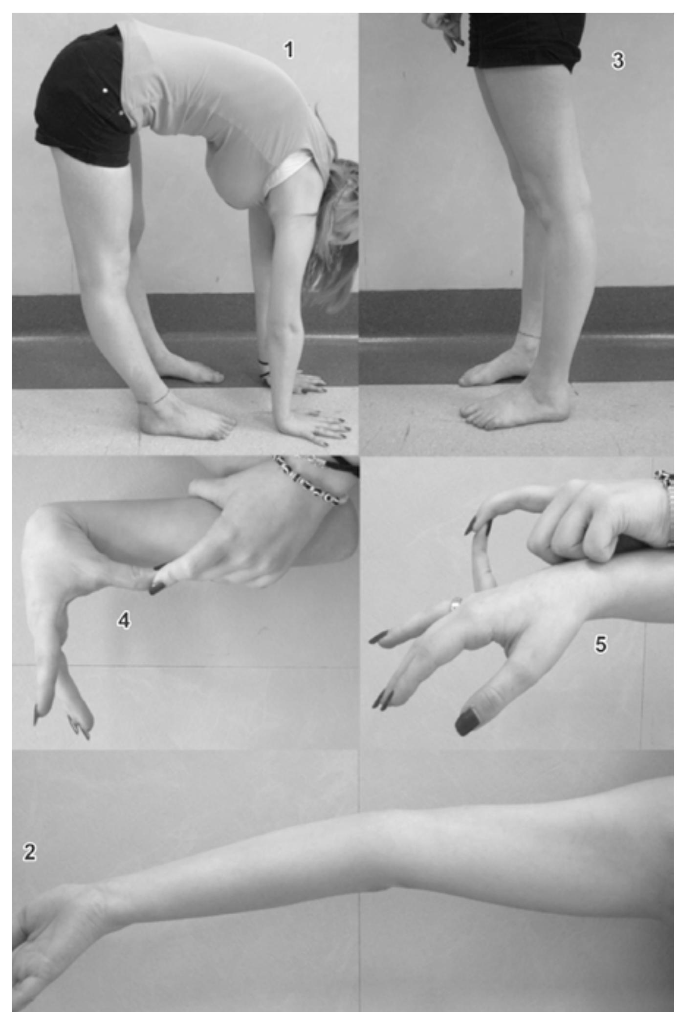 (PDF) The multifaceted and complex hypermobility syndrome (a.k.a ...