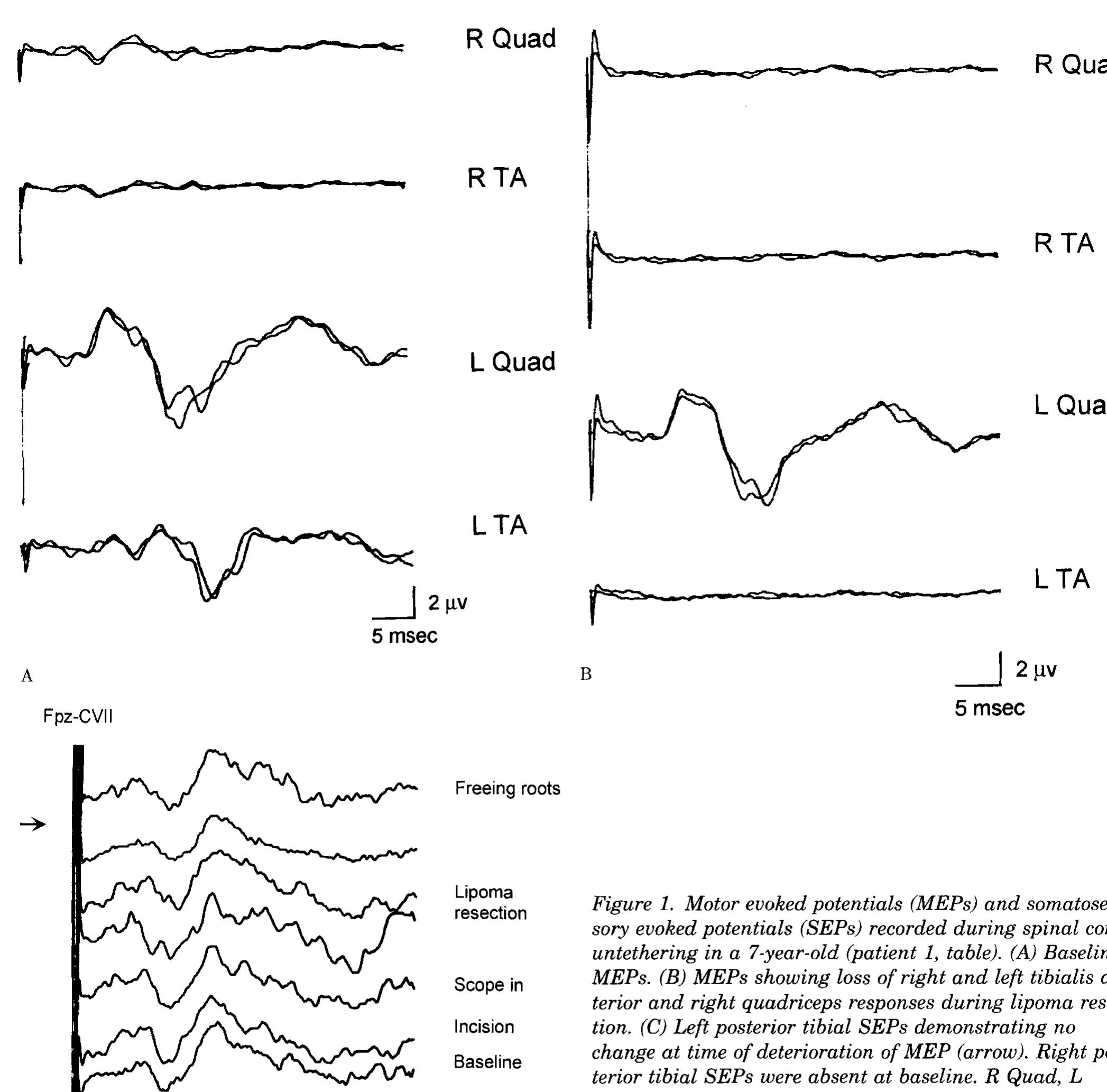 (PDF) Intraopreative motor and somatosensory evoked potentials ...