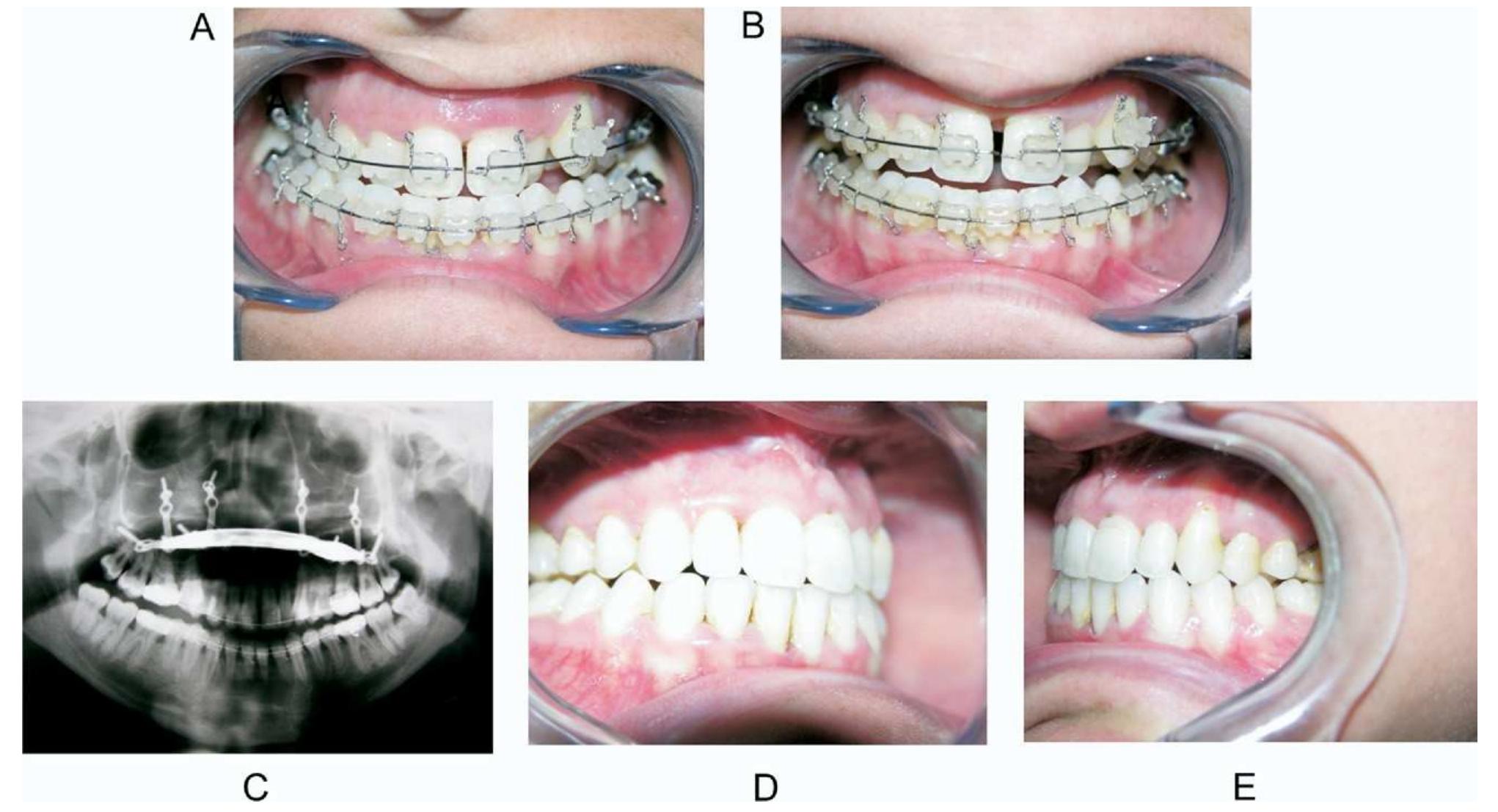 Distraction View Patient 1. a, preoperative occlusal frontal view. b,