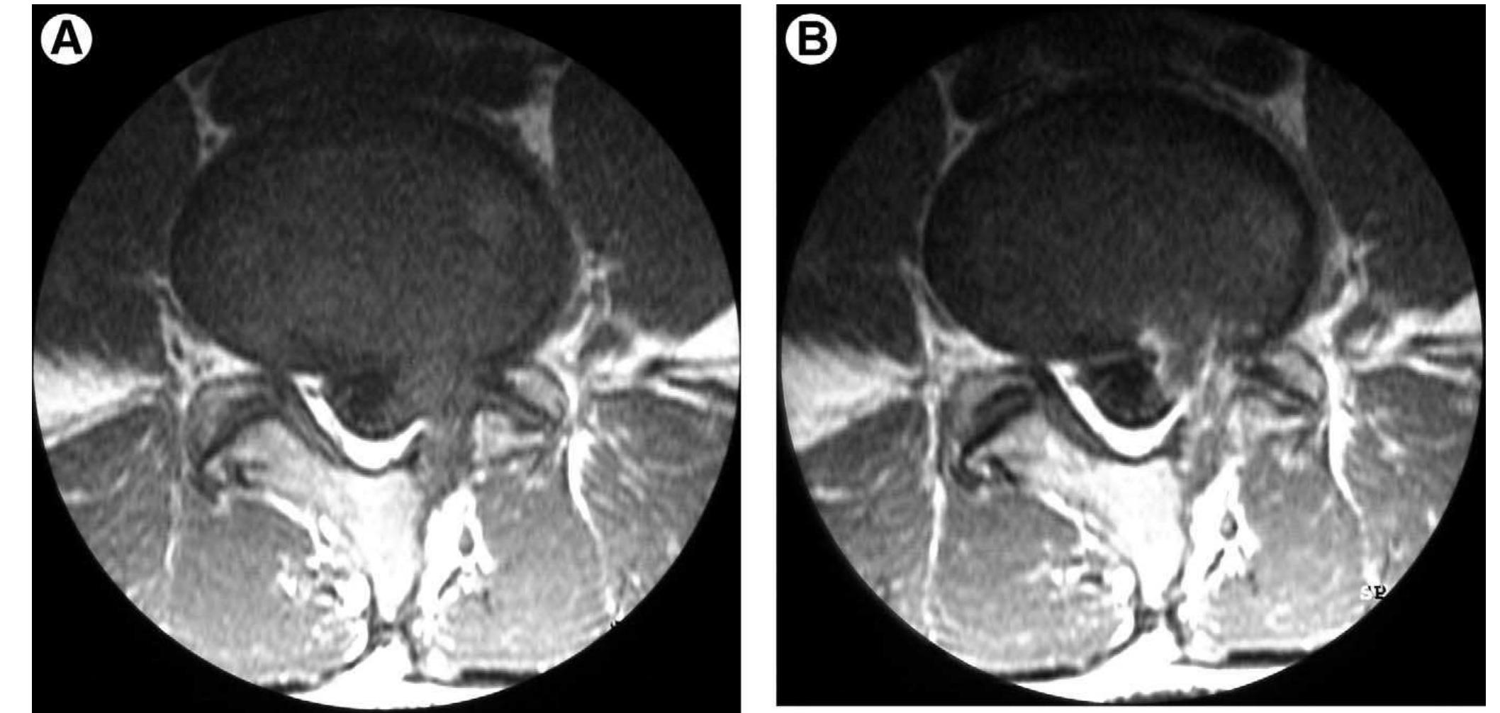 (PDF) Imaging of the Postoperative Spine