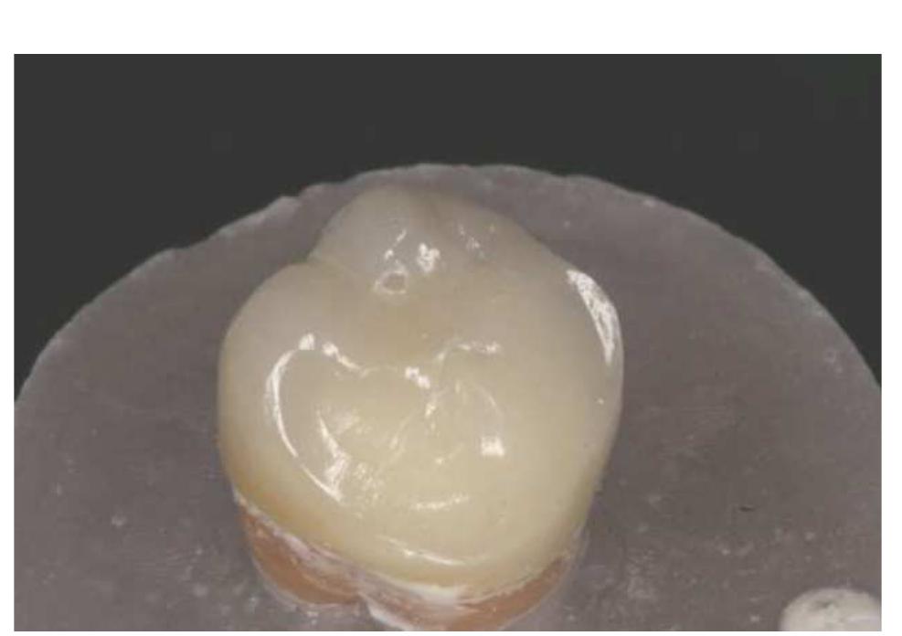 (PDF) Fracture resistance and failure patterns of endodontically ...