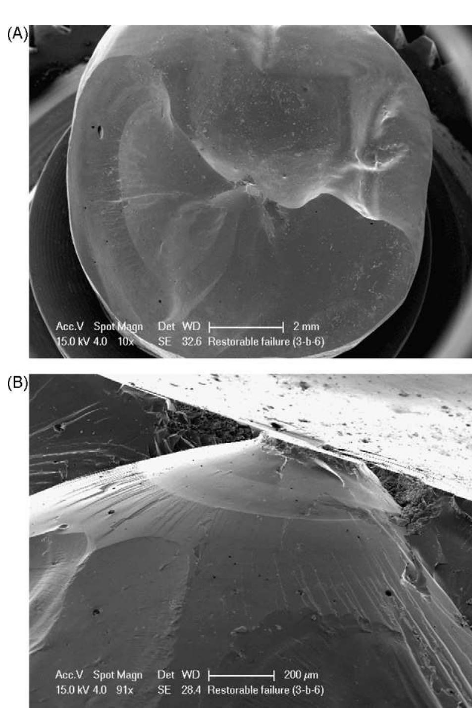(PDF) Fracture resistance and failure patterns of endodontically ...