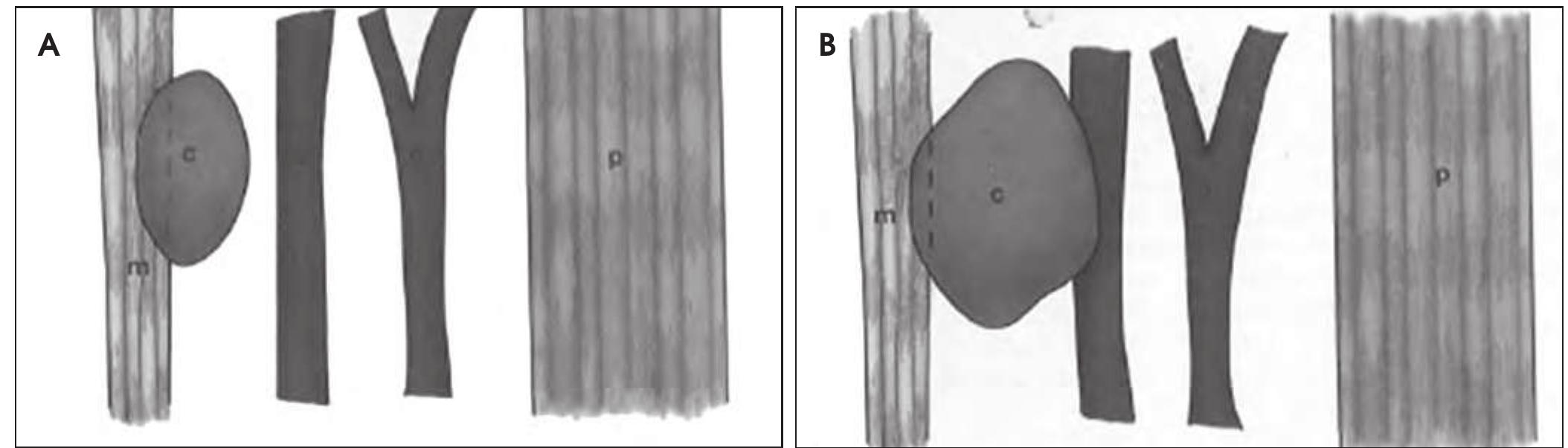 (PDF) Congenital Cystic Lesions of the Neck