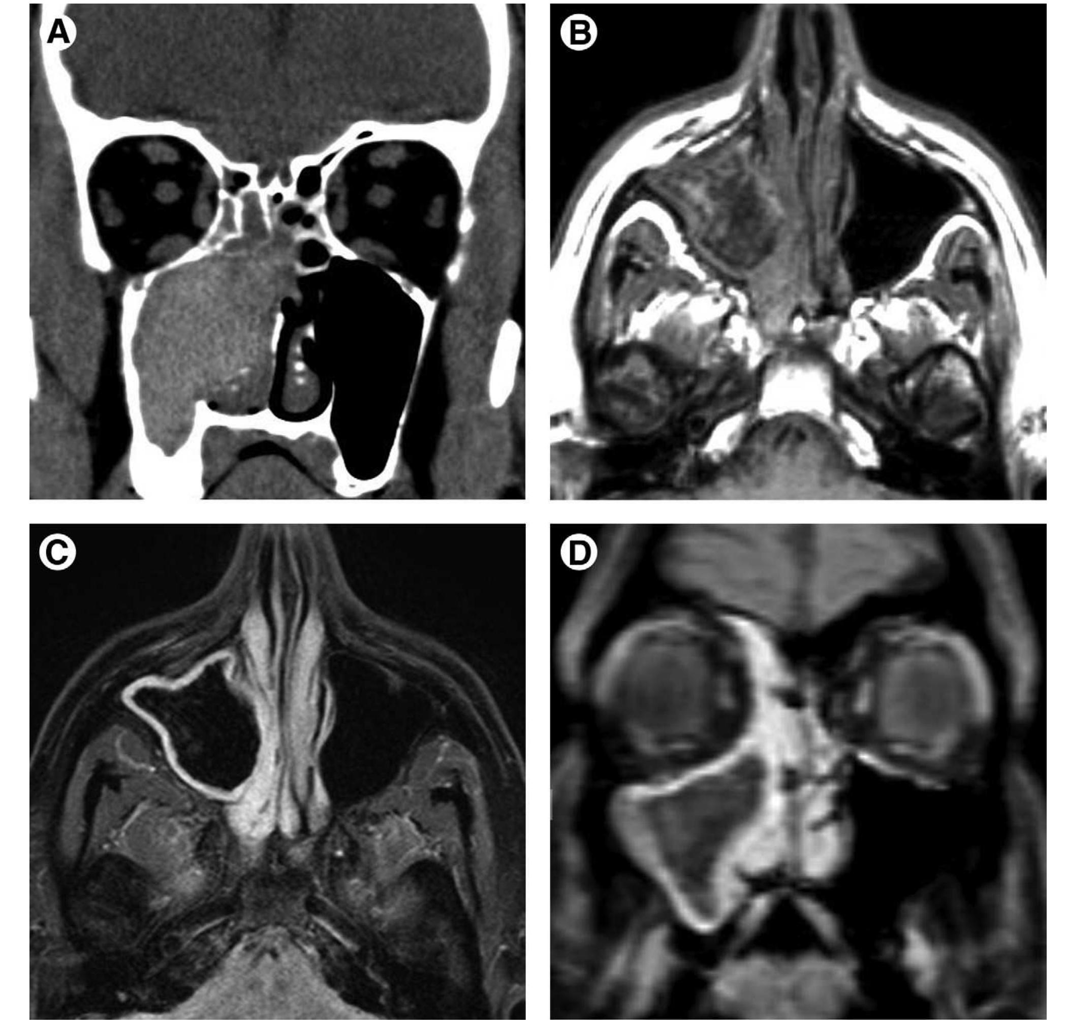 (PDF) Imaging of the Paranasal Sinuses