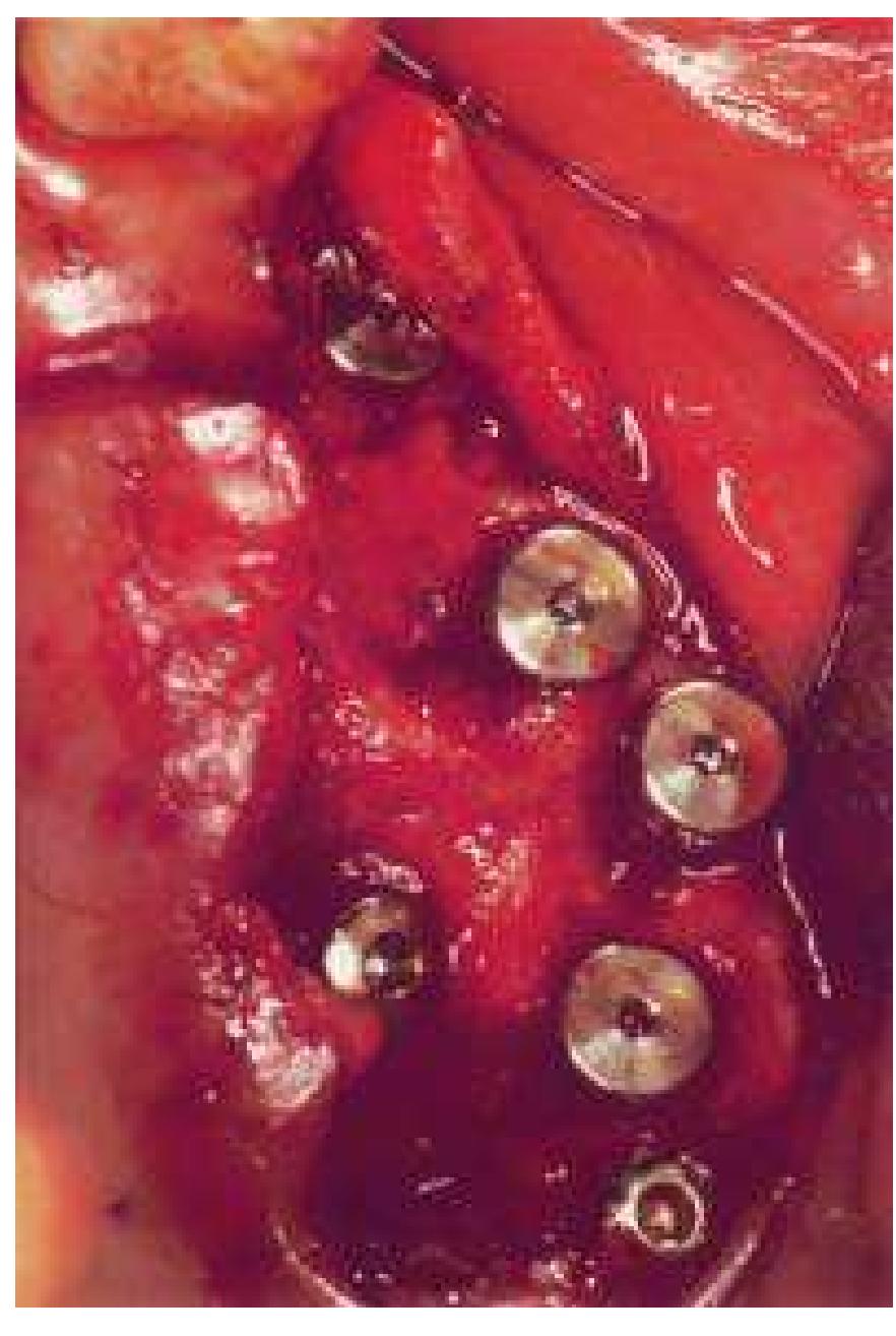 Figure 12 - from Immediate Implantation in Fresh Extraction