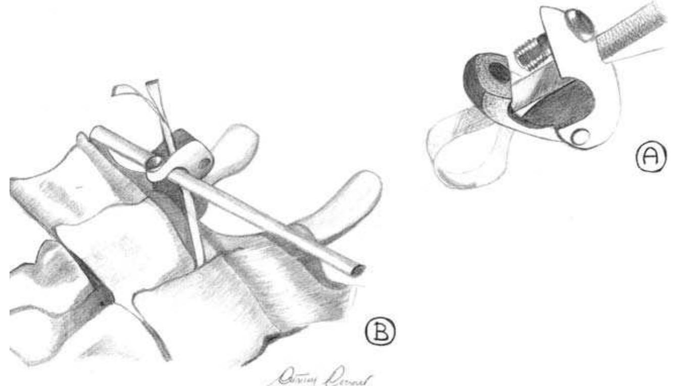 (PDF) Universal Clamp system in thoracolumbar spinal fixation ...
