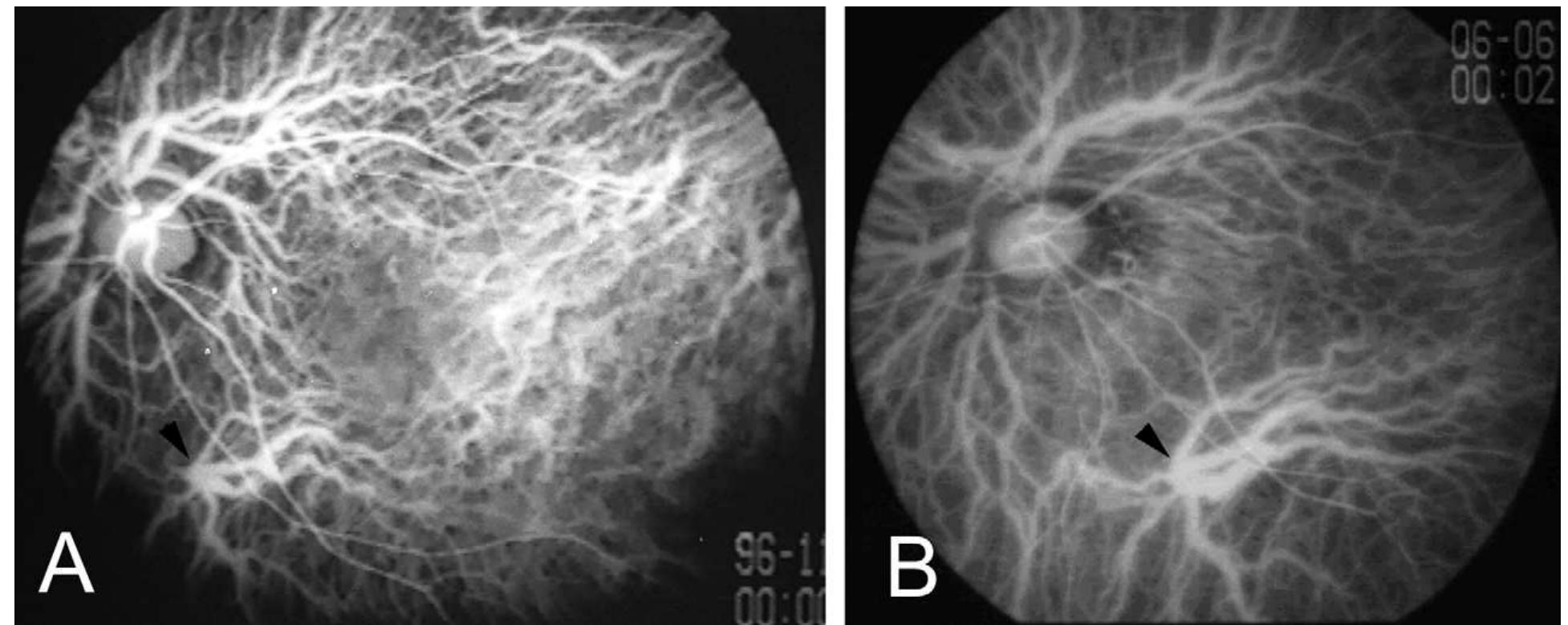 (PDF) Morphology and Long-term Changes of Choroidal Vascular Structure ...
