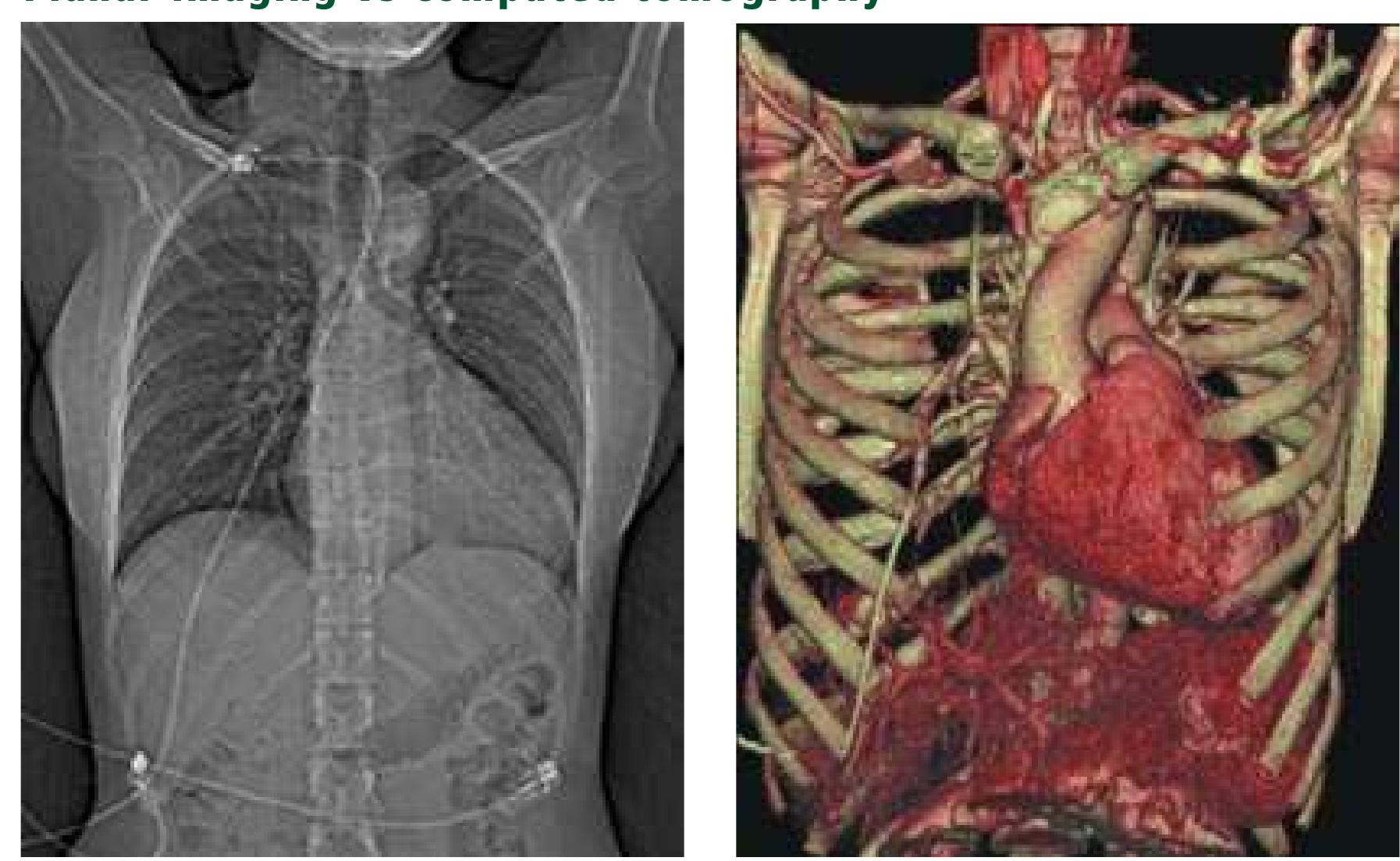 Left, the standard chest radiograph is a planar projection.