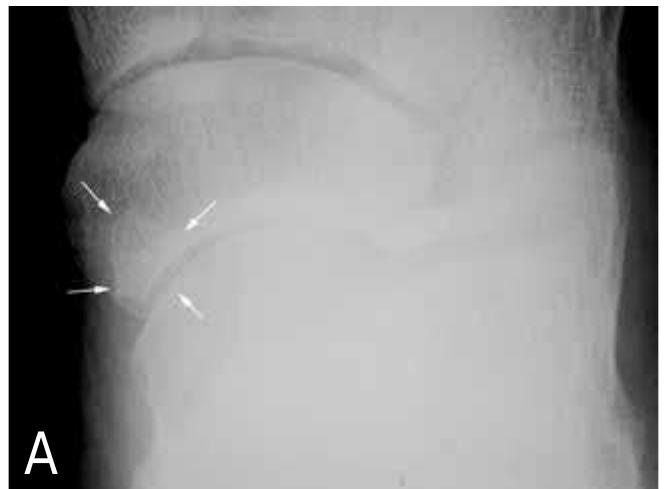 Normal Variant Navicular Development (PDF) Accessory navicular bone: not such a normal variant