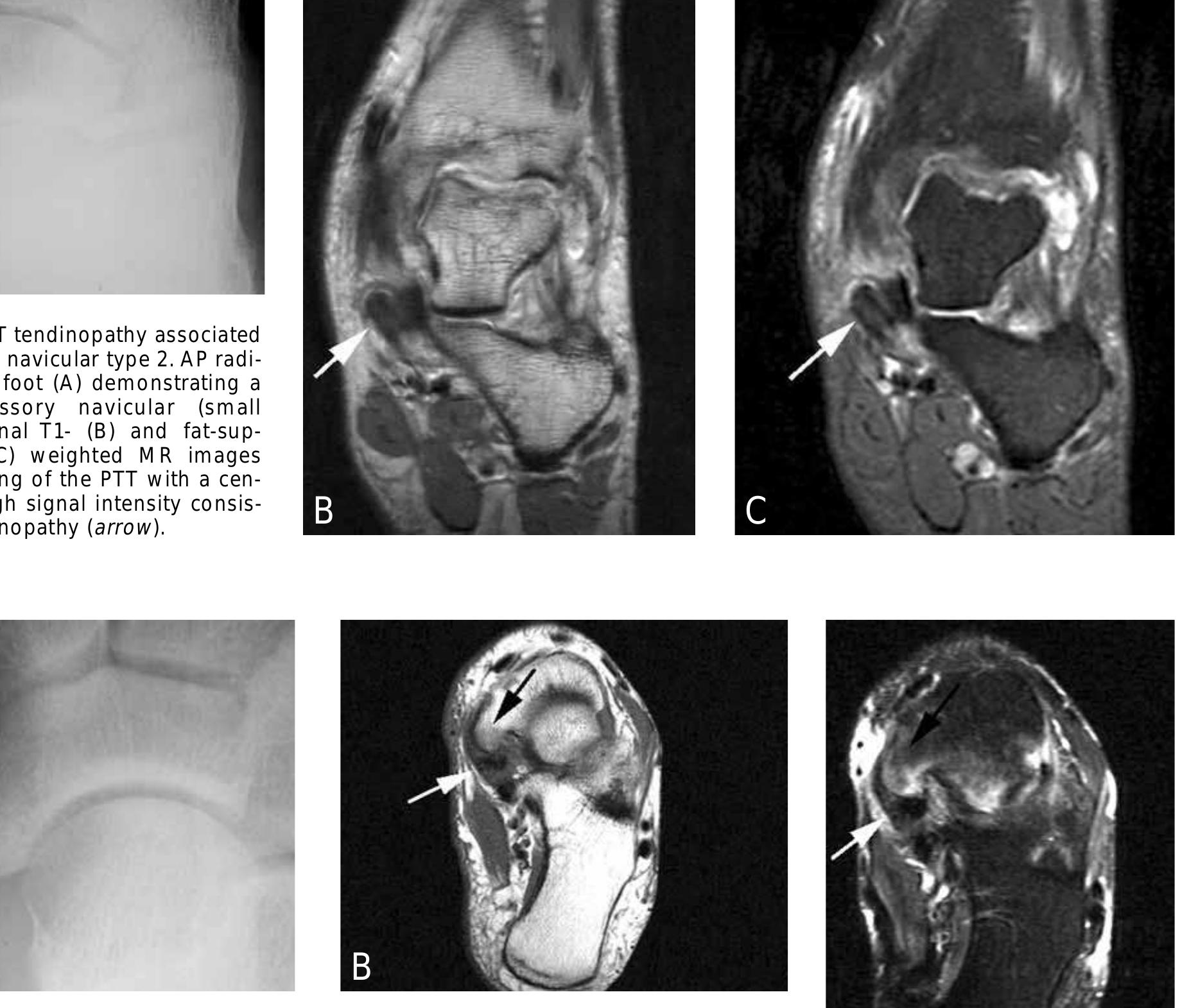 (PDF) Accessory navicular bone: not such a normal variant