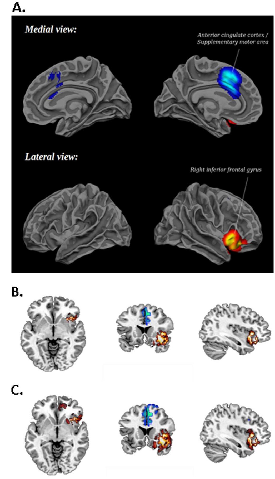 (PDF) Effects Of Stimulants On Brain Function In Adhd: A Systematic ...