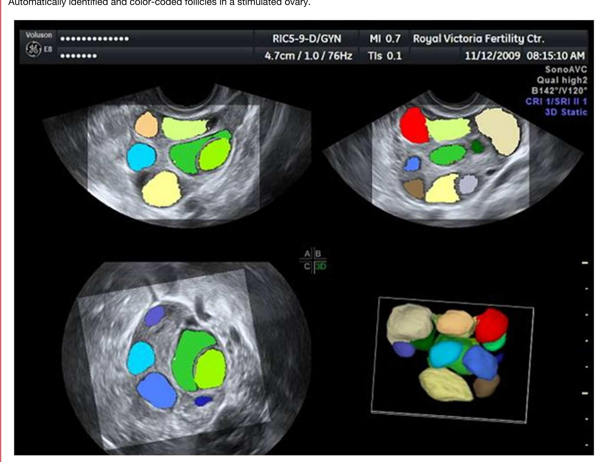 (PDF) Ultrasound automated volume calculation in reproduction and in ...