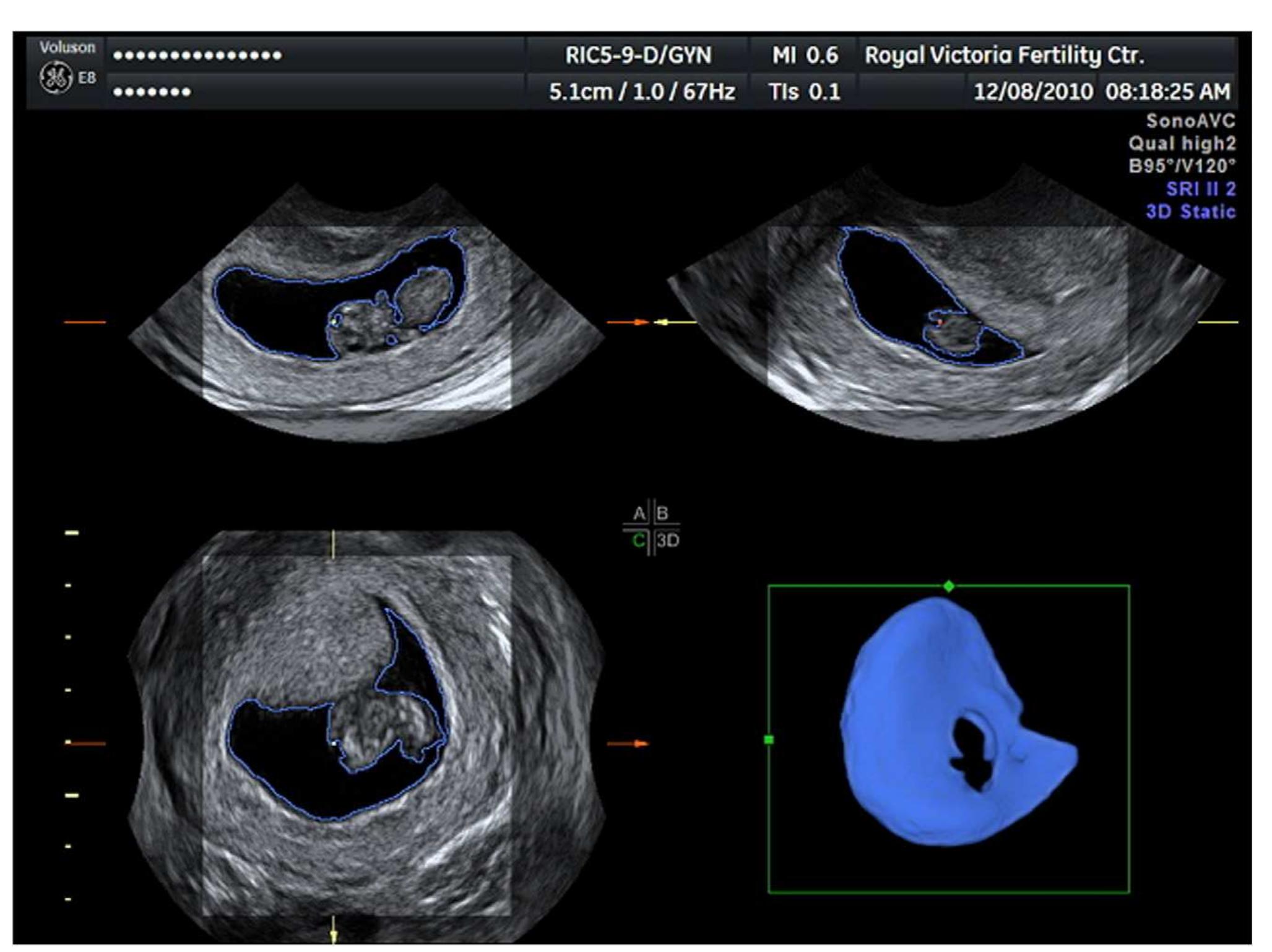 (PDF) Ultrasound automated volume calculation in reproduction and in ...
