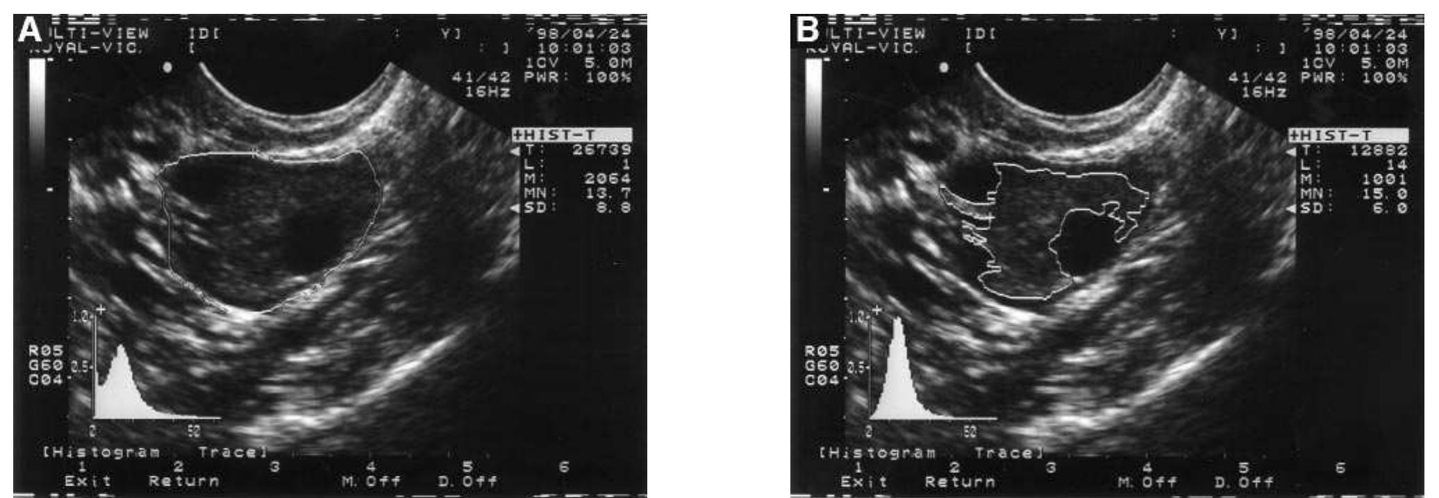 Figure 1 - from Ovarian stromal echogenicity in women with