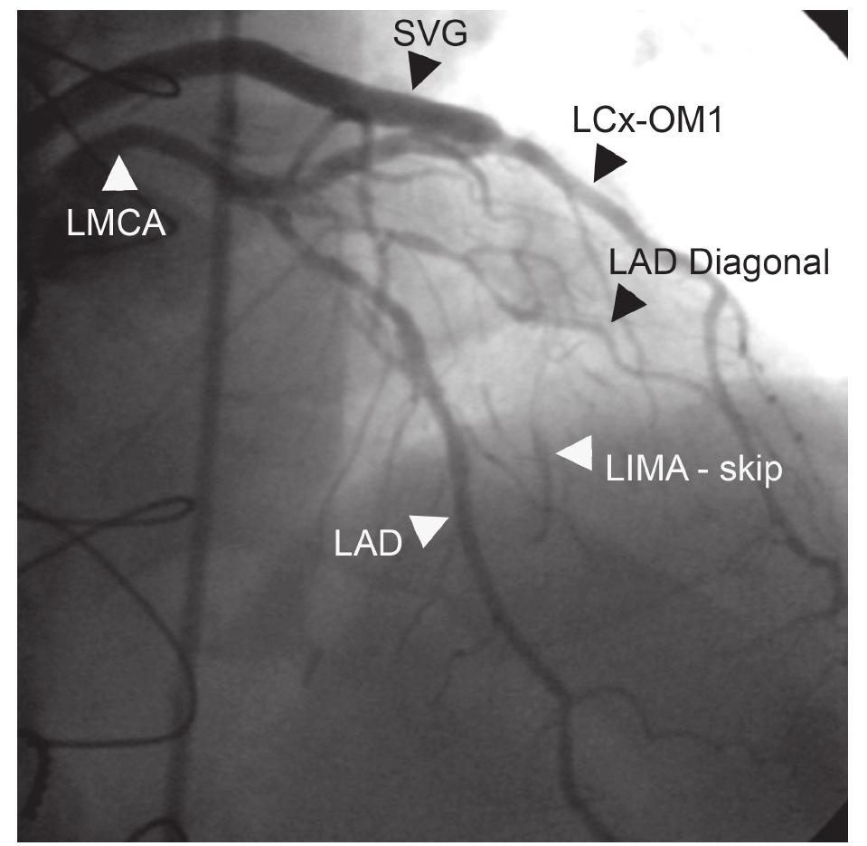 Obtuse Marginal Number Cineangiogram in anteroposterior cranial view shows the