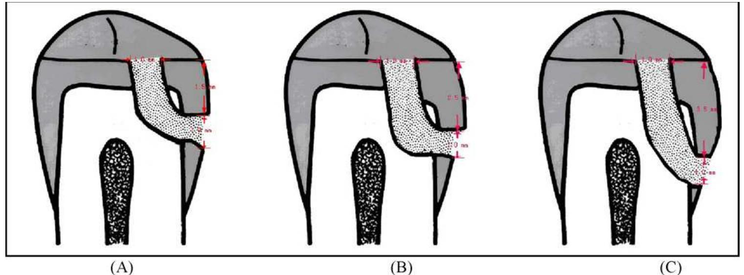 (PDF) Strength of tunnel-restored teeth with different materials and ...