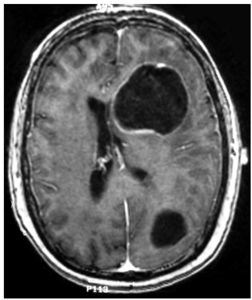 Axial tl-weighted mri of the brain with intravenous contrast