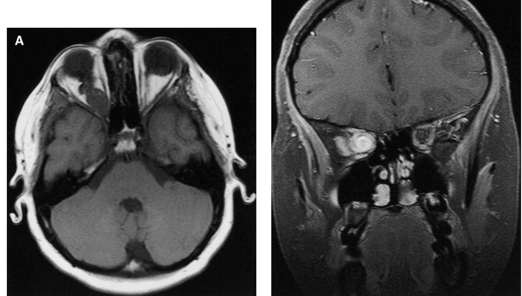 (PDF) Neuroimaging findings in neurofibromatosis type 1 and 2
