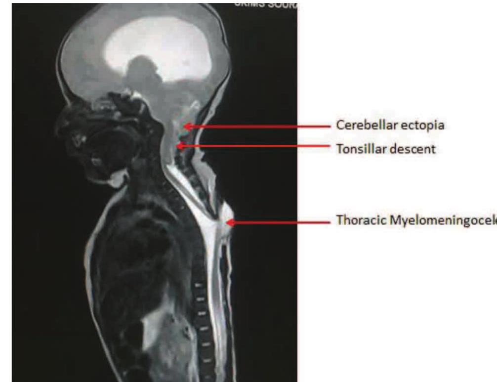 -2: demonstrating arnold chiari malformation with thoracic