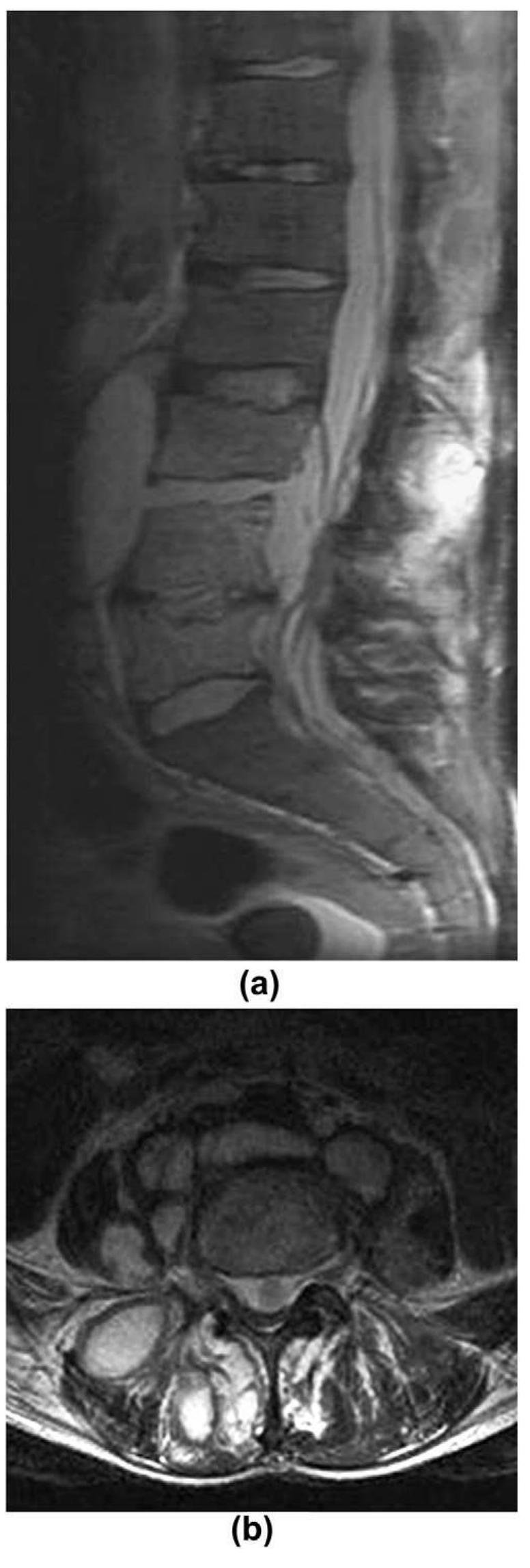 T2-weighted images mri images of the lumbar spine in the