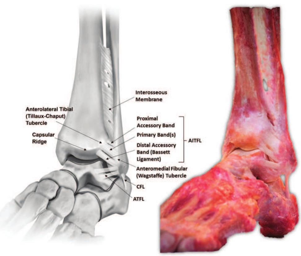 (PDF) Ankle syndesmosis: a qualitative and quantitative anatomic analysis