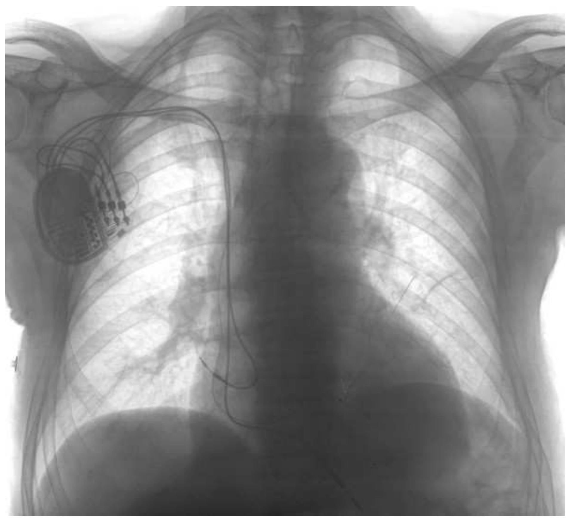Transvenous Icd Incision (PDF) Extraction Of Transvenous ICD Leads In An Over-ninety Years Old ...